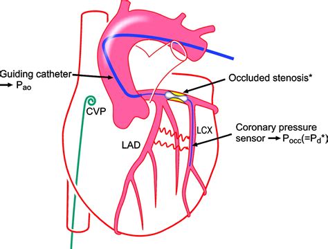 assessment   human coronary collateral circulation circulation