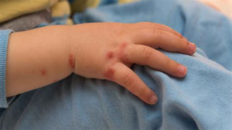hand foot mouth disease