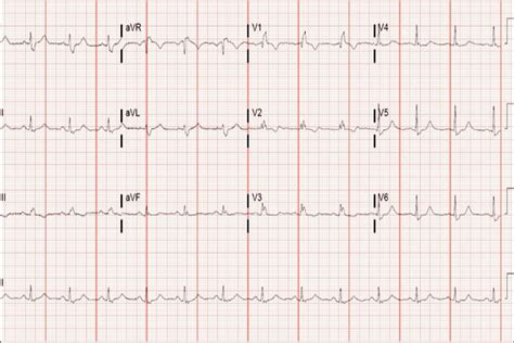 A 42 Year Old Male With An Abnormal Ecg Journal Of Urgent Care Medicine