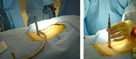 Minimally Invasive Spinal Surgery Sydney Spine Doc