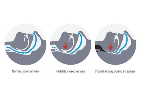 obstructive  central sleep apnea differences resmed