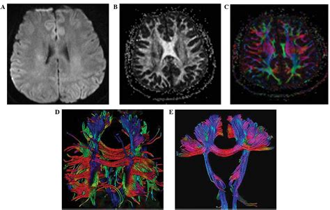 Magnetic Resonance Diffusion Tensor Imaging For Occult Lesion Detection