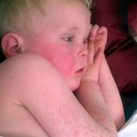 Cases Of Scarlet Fever Are On The Rise In The Uk Health And Medicine