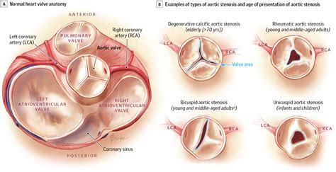 Asymptomatic Aortic Stenosis In The Elderly A Clinical Review