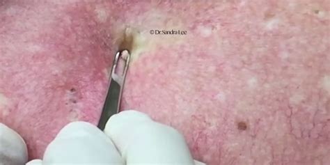 Dr Pimple Poppers Newest Video Is Both Horrifying And Fascinating