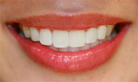 tooth whitening problems   avoided brookside dental