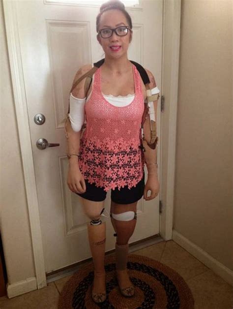 Meet The Human Mannequin Brave Woman Who Lost Limbs To Meningitis