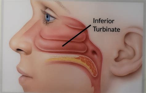 nasal turbinate hypertrophy   york ny  nose institute