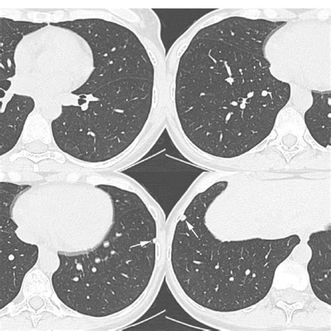 Axial Thin Section Ct Images With Lung Window Setting Show Multiple