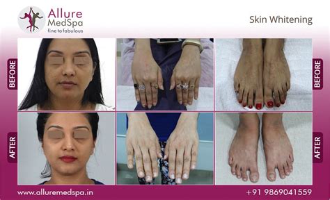 skin whitening treatment skin lightening cost  mumbai india
