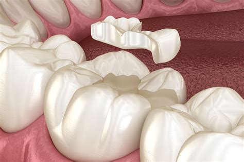 inlays  onlays annapolis md treat cavities  rear teeth