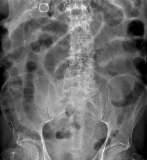 Small Bowel Obstruction X Ray Photograph By Du Cane Medical Imaging