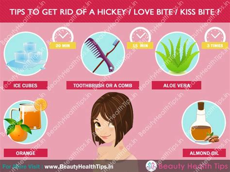 how to get rid of a hickey love bite kiss bite