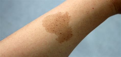 birthmarks dermatology  skin health dr mendese