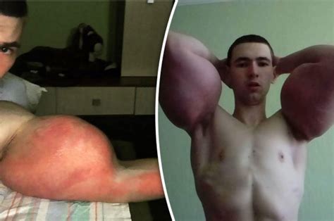 ‘freak who injected homemade potion into biceps now facing amputation