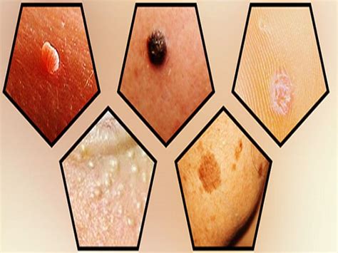 skin care how to remove moles warts blackheads skin