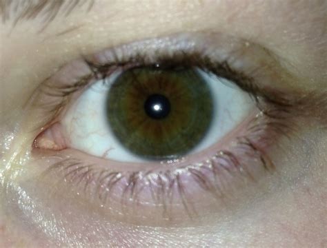 My Eyes Used To Be Dark Brown Now They Are Half Brown And
