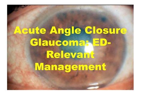 acute angle closure glaucoma ed relevant management emdocs