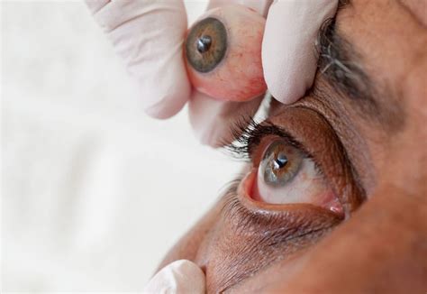 artificial eye discomfort southeastern ocularists