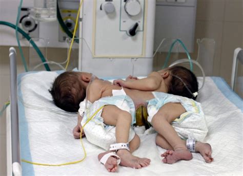 Conjoined Palestinian Twins Who Share Heart Can T Be Separated Ctv News