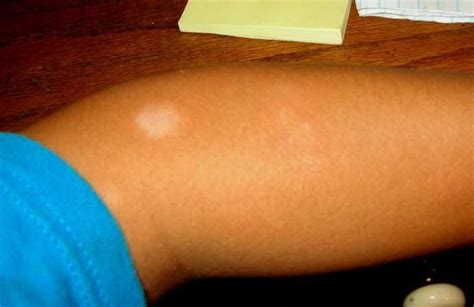 white spots  skin  pictures treatment symptoms diseases pictures