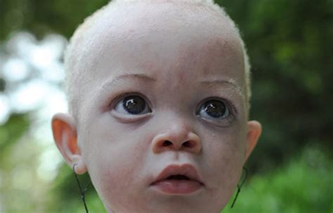 albinos  murdered  tanzania