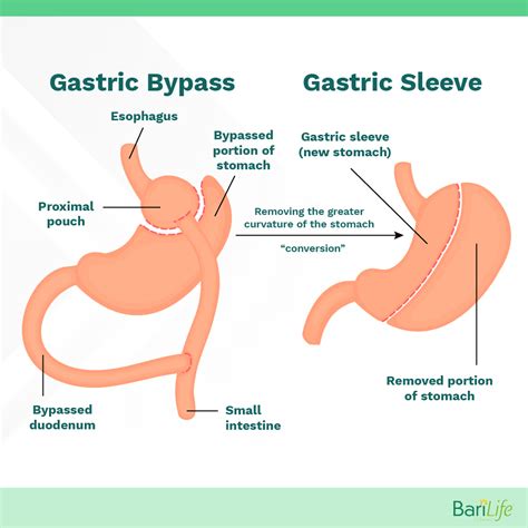 gastric sleeve  gastric bypass
