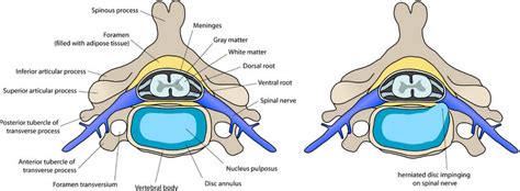 Herniated Disc Settlements Car Accidents And More