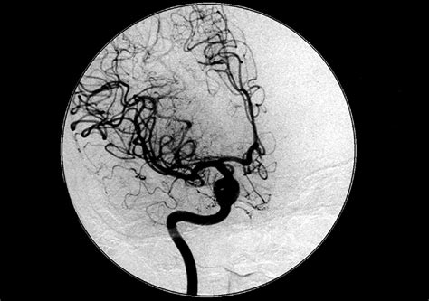 basilar artery aneurysm  autonomic features  interesting
