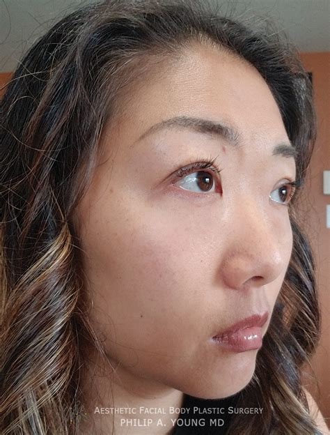 Asian Double Eyelid Crease Procedure Seattle Bellevue