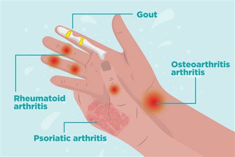 arthritis  hands symptoms types  hand arthritis  treatment