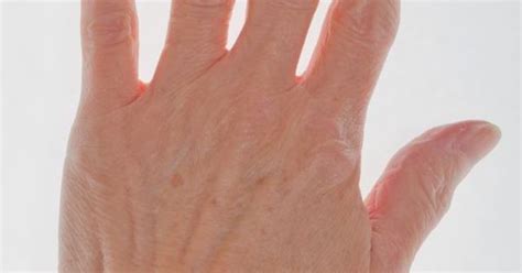 reasons   lumps  bumps   wrist finger arthritis
