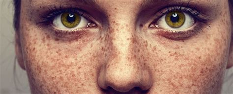 scientists  dont     freckles sciencealert