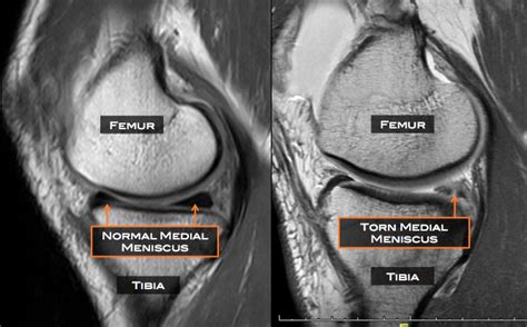 Not All Meniscal Pathology Is Relevant In Patients With Knee Oa