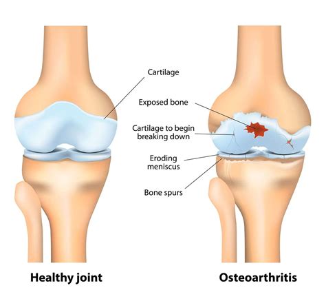 osteoarthritis novus spine pain center  lakeland florida