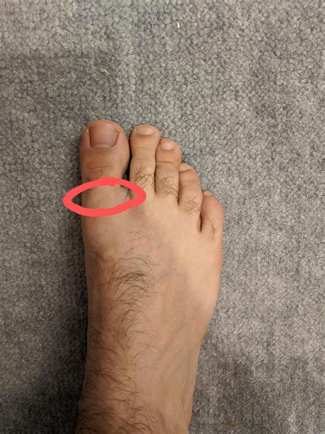 big toe joint pain footfunction