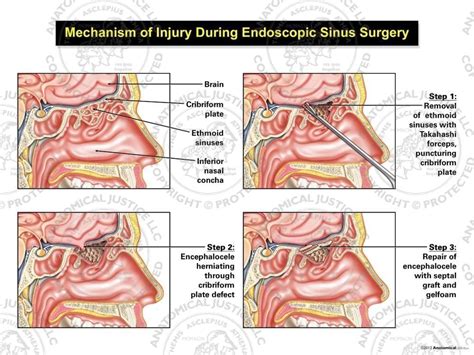 mechanism  injury  endoscopic sinus surgery