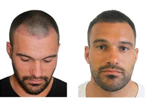 Is Hair A Transplant Right For You Harcourt Health