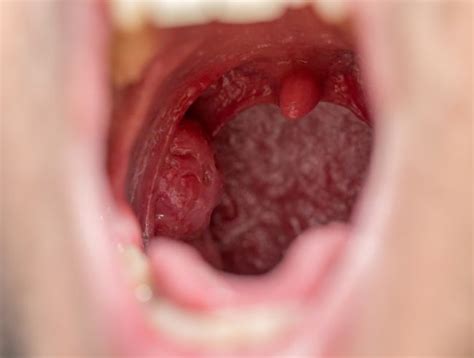 10 signs of strep throat facty health
