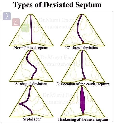 correcting  deviated septum