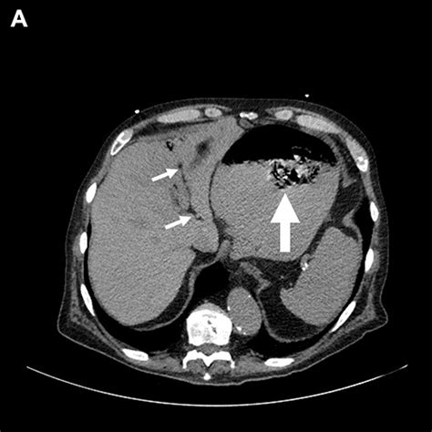 Asymptomatic Complete Transmural Gastric Migration Of