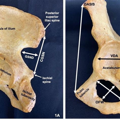 Left Hip Bone Showing Some Relevant Anatomical Structure