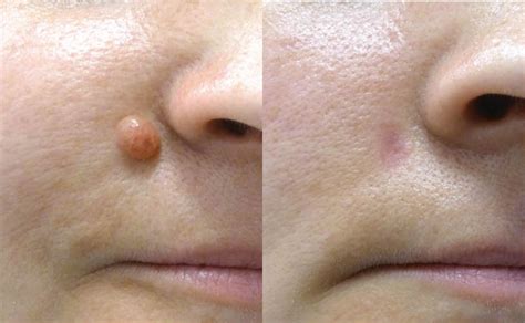 mole removal cream skincell pro advanced skin tag mole removal