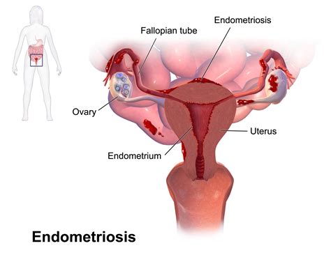 physiotherapy   management  endometriosis fiona mitchell physio