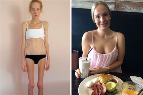Recovered Anorexic Given Just 48 Hours To Live Shares Harrowing Photos