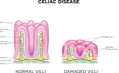 celiac disease symptoms  treatment  diagnosis findatopdoc