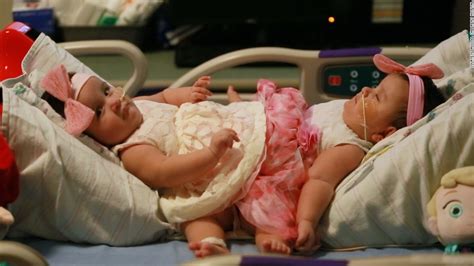 conjoined sisters undergo rare separation surgery cnn