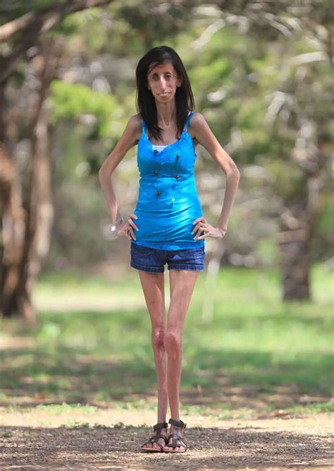Skinniest Person In The World Top 7 Thinnest People In 2023
