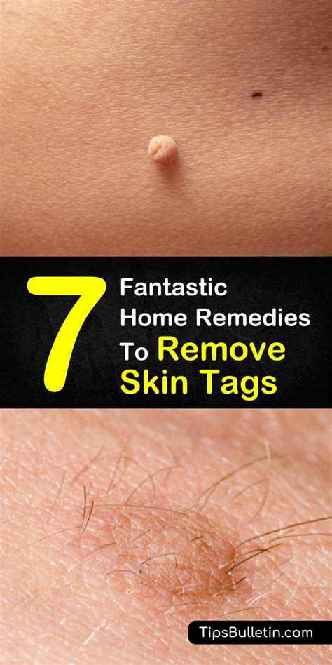 7 fantastic home remedies to remove skin tags