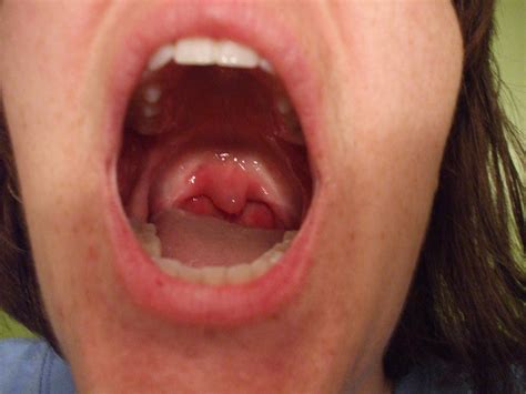 simple   sounds  swollen uvula